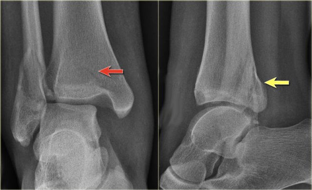 Weber B fracture