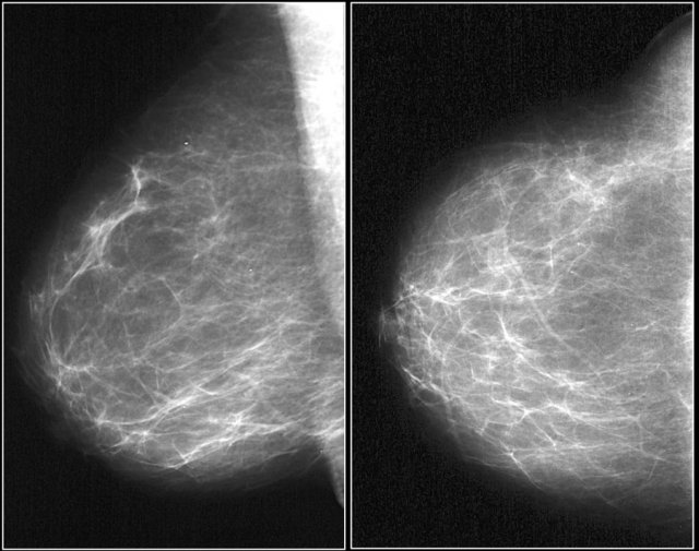 BI-RADS 1 (normal). There is nothing to comment on.