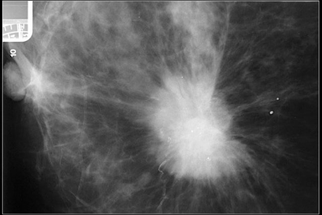 High density mass with spiculated margin