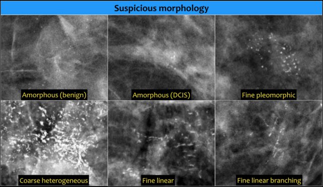 Amorphous, indistinct microcalcifications