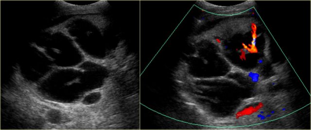 Central dot sign in Caroli disease