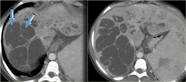 Central dot sign in Caroli disease