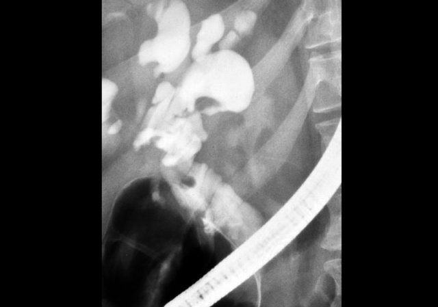 ERCP: Caroli disease with severe intrahepatic duct dilatation. No obstruction. Mild dilatation of the choledochal duct due to cholangitis