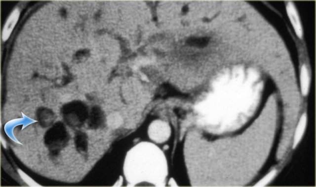 Caroli disease with intraductal stone formation