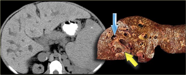 Cirrhosis in a patient with Caroli disease