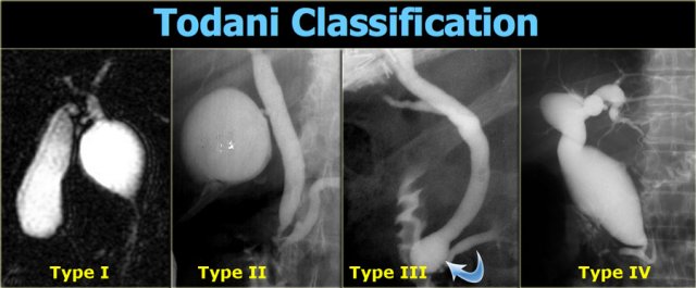 Todani Classification of choledochal cysts