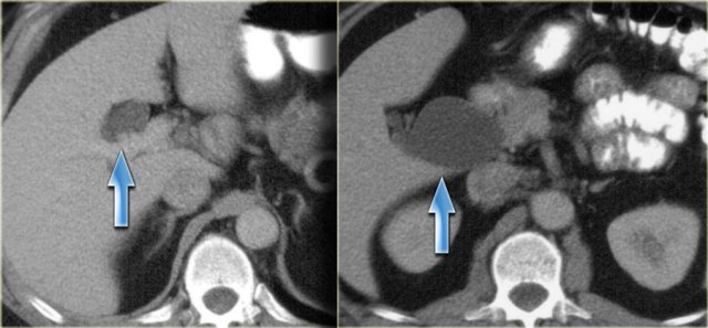 Type IV choledochal cyst