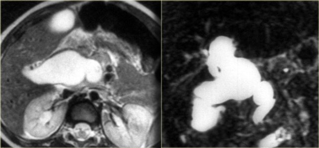 Type IV choledochal cyst