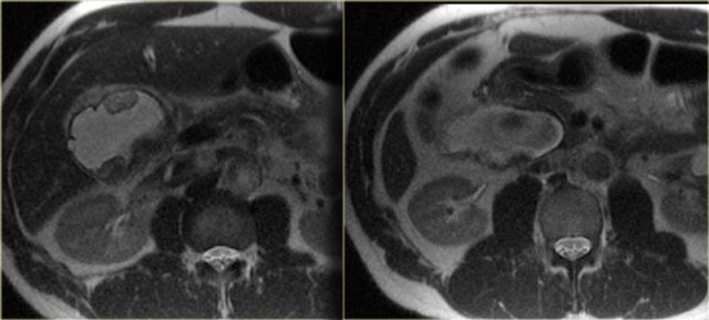 Cholangiocarcinoma within a choledocha cyst