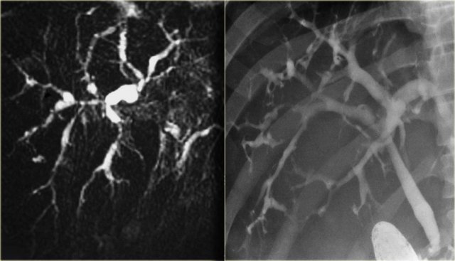 Primary sclerosing cholangitis: MRCP and ERCP