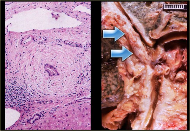 Chronic inflammation surrounding a bile duct in PSC