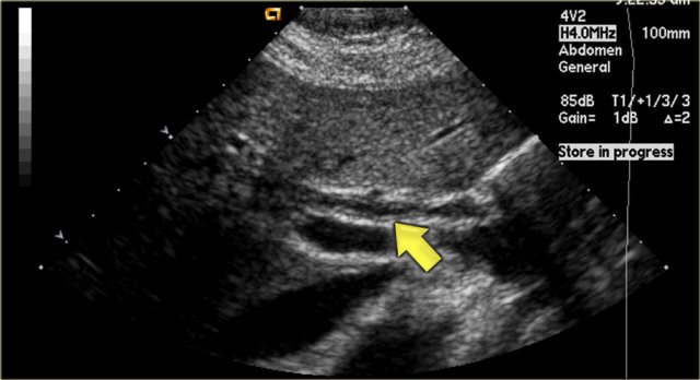 PSC with thickening of the wall of the bile duct (arrow)