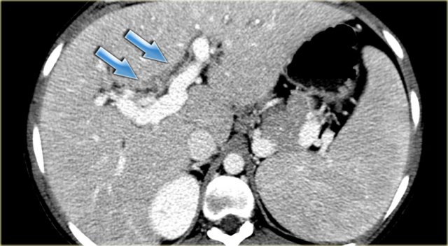 Primary sclerosing cholangitis. CT findings