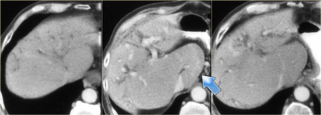 Primary sclerosing cholangitis. late CT findings