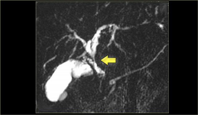 MRCP in PSC. There is a long stricture suspective of cholangiocarcinoma (arrow)