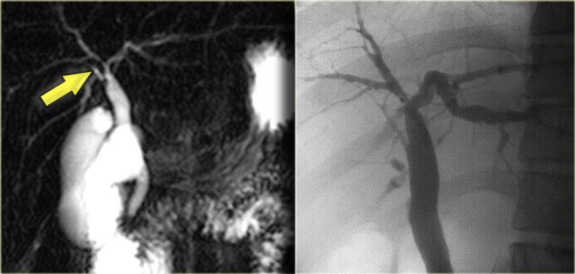 MRCP and ERCP in a patient with a stricture at the hilum