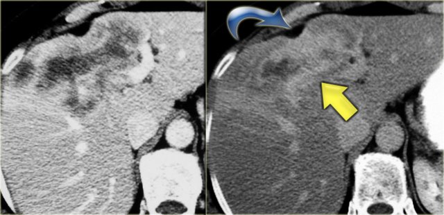 Intrahepatic cholangiocarcinoma. Capsular retraction and the late enhancement