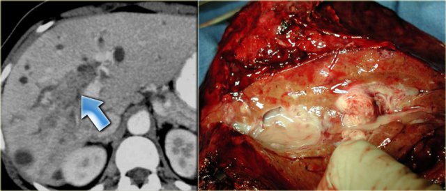 Intraductal Cholangiocarcinoma