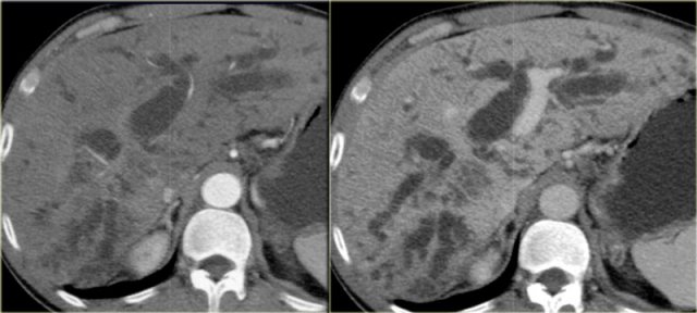 Klatskin Tumor: arterial and portal venous phase