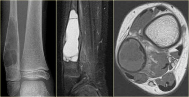 ABC in distal tibia