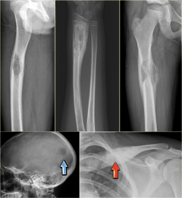 Various presentations of eosinophilic granuloma