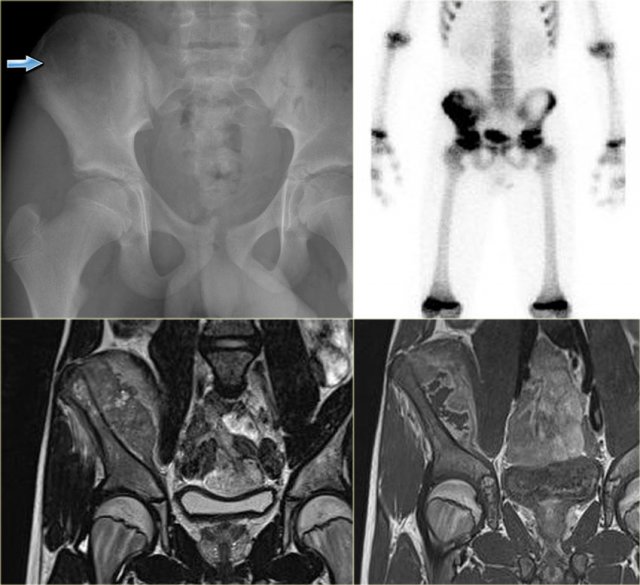 Ewing sarcoma 