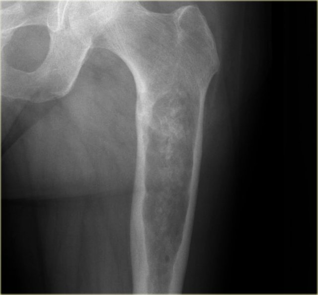 Chondrosarcoma