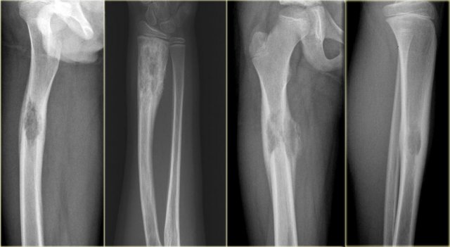 Eosinophilic granuloma with ill-defined borders.