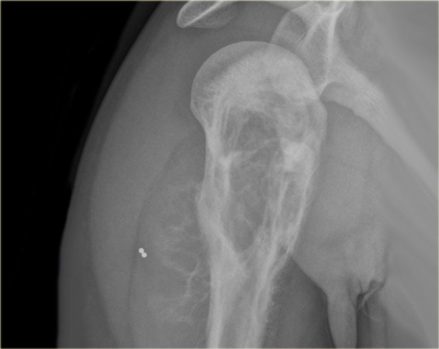 Osteosarcoma