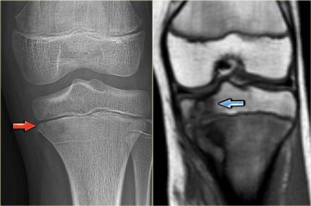 Osteomyelitis