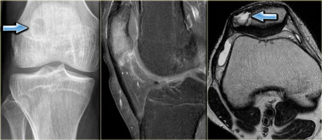 Chondroblastoma: notice extensive edema (middle) and fluid-fluid level due to secondary ABC.