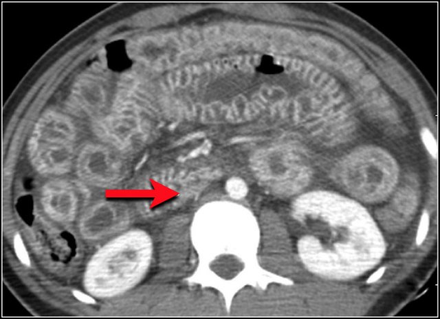 Shock bowel with hyperenhancement. Slit-like IVC (red arrow).