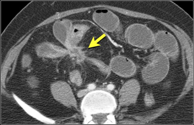 Fistula formation in a patient with Crohn's disease.