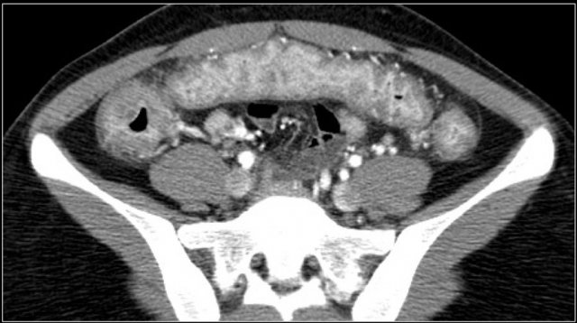 Acute inflammatory bowel disease.