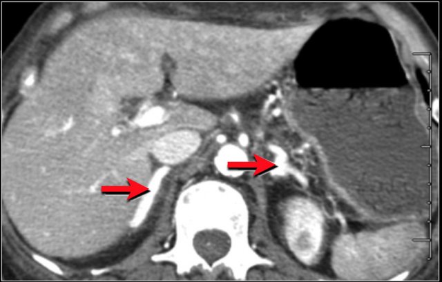 Hyperenhancing adrenal glands in shock.