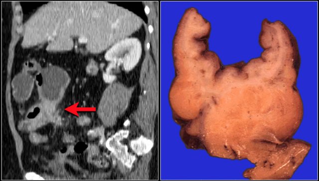 Gray enhancement pattern in a patient with chronic Crohn's disease.