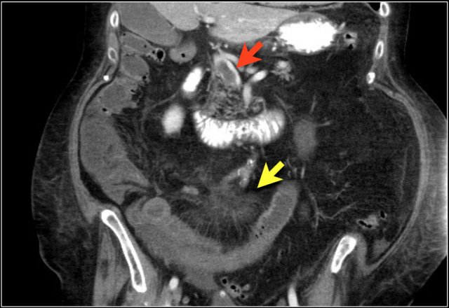 Gray enhancement pattern in a patient with SMV thrombosis.