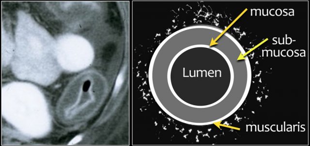 Target sign with submucosal edema.