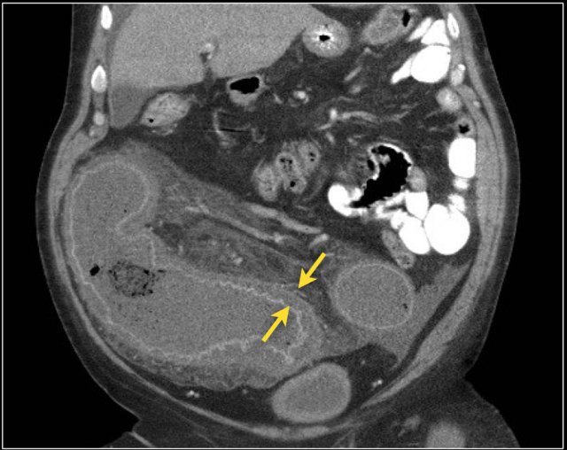 Pseudomembranous Colitis with dilatation of the sigmoid.