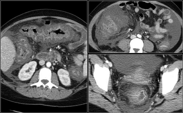 Pseudomembranous colitis