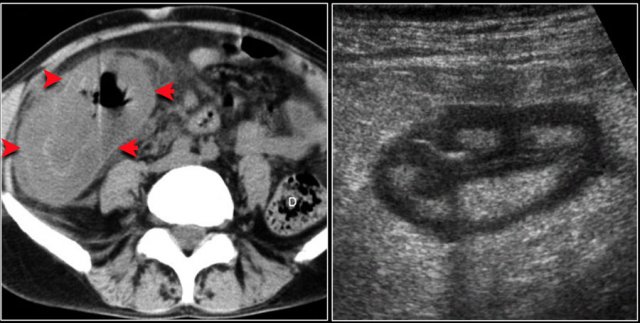 Typhlitis in a patient with neutropenia.