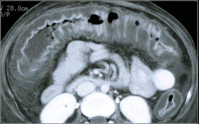 CMV-colitis.