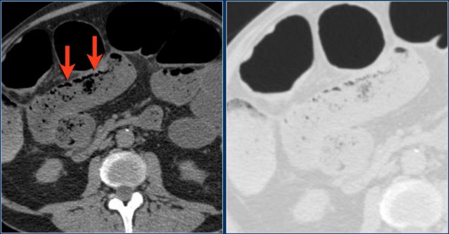 Pseudopneumatosis in SBO.