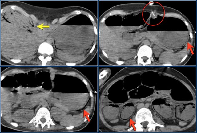 Pneumatosis after insertion of a PEG-tube.