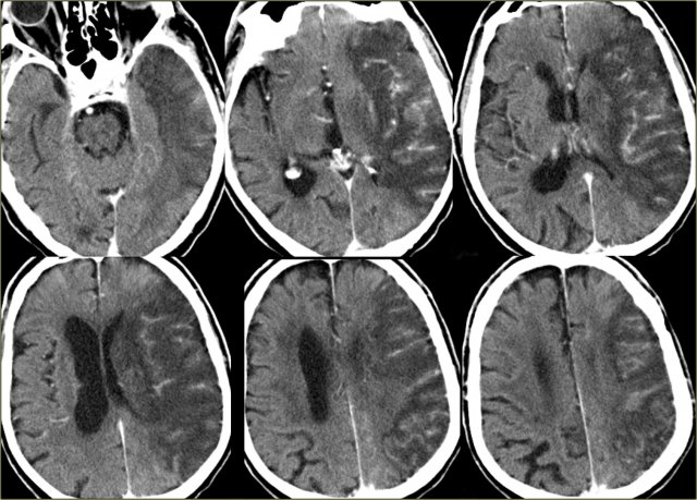 MCA infarction with luxury perfusion