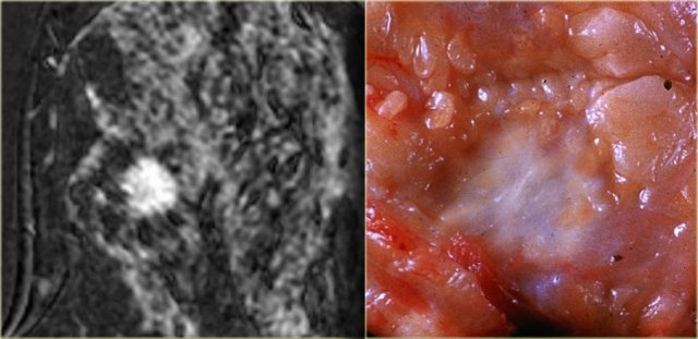 Invasive ductal carcinoma with spiculated margins