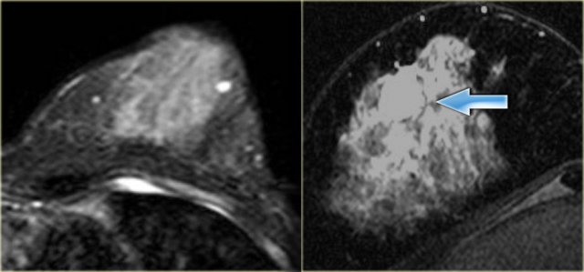 Fibroadenoma (left) and a colloid carcinoma (right). Both are bright on T2WI.