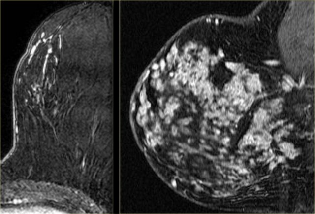 LEFT: segmental DCIS RIGHT: regional DCIS