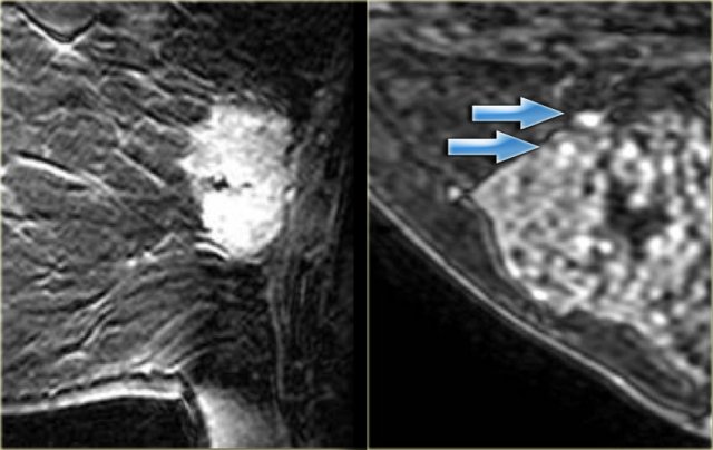 LEFT: Heterogeneous enhancement in invasive ductal carcinomaRIGHT: Punctate enhancement  in a hamartoma with fibrocystic change (arrows)