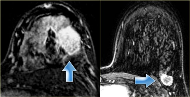 Two cases of intraductal carcinomas